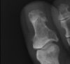 SD HALLUX Oblique.jpg